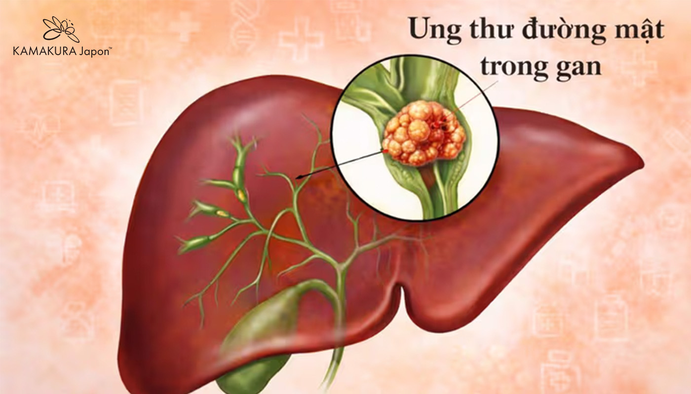 Tiến bộ trong điều trị Ung thư Gan và Ung thư Đường mật bằng liệu pháp miễn dịch