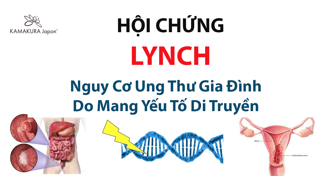 Hội chứng Lynch - Nguy cơ ung thư gia đình do đột biến gen: Triệu chứng, Chẩn đoán và Điều trị Toàn diện